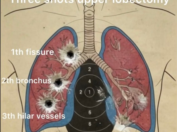 Lobectomia superiore destra toracoscopica con sezione simultanea dei vasi arteriosi e&nbsp;venosi