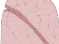 Fissure less technique per il trattamento delle scissure&nbsp;incomplete