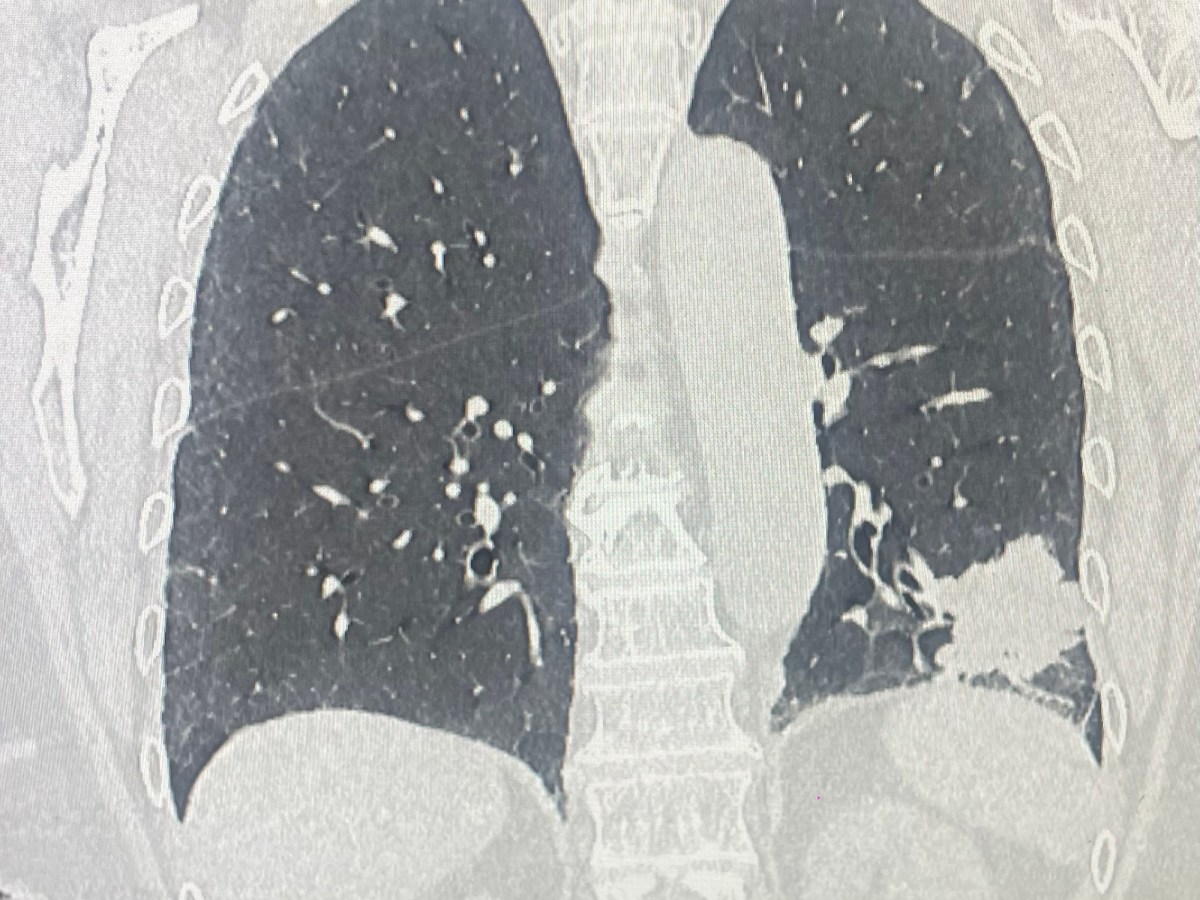 Lobectomia robotica fissure last&nbsp;technique