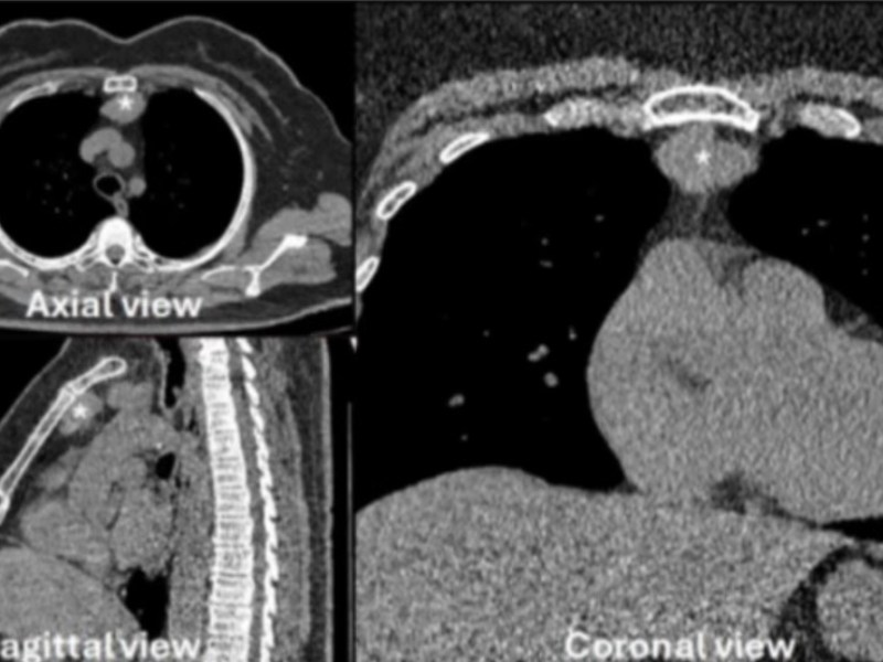 Riparazione della pleura mediastinica con patch di collagene in corso di timectomia&nbsp;robotica