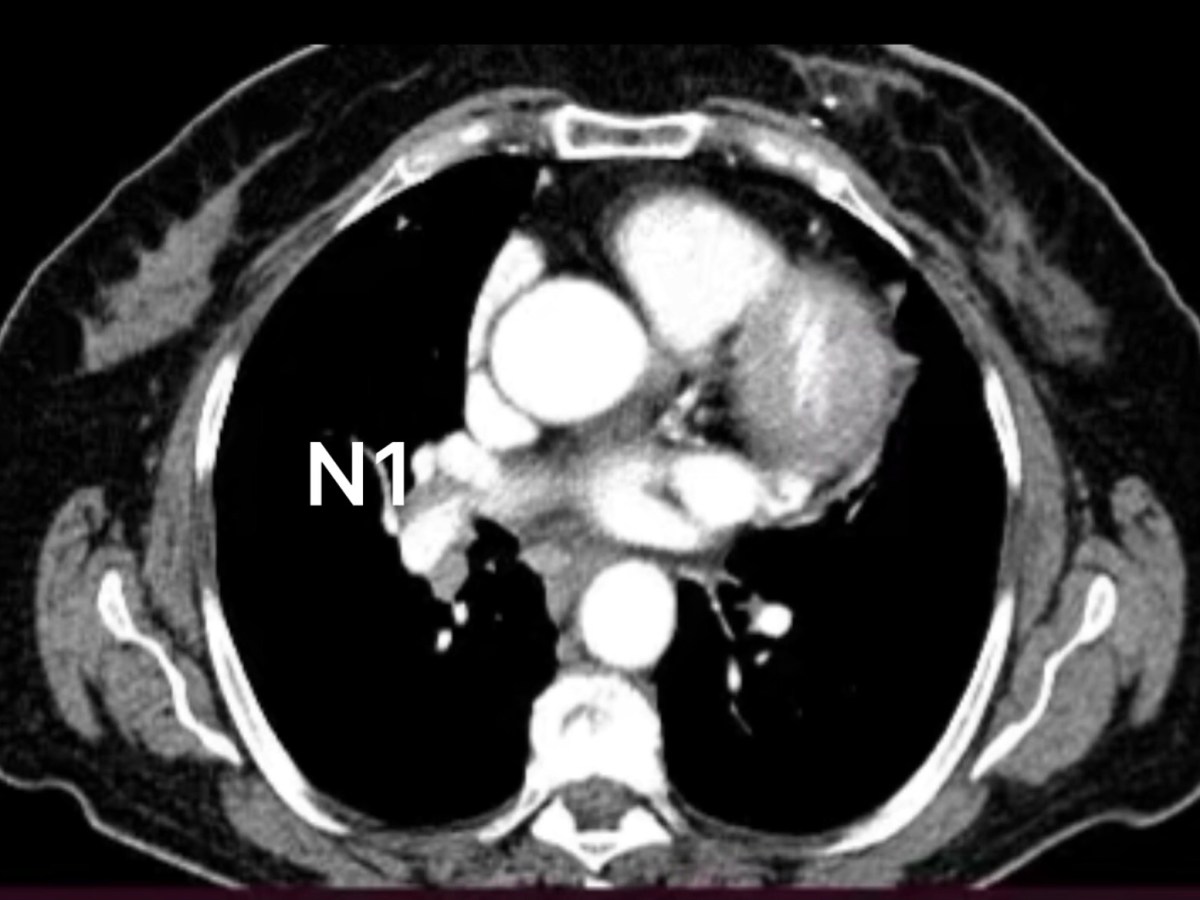 Il trattamento chirurgico del cancro del polmone con metastasi dei linfonodi&nbsp;ilari