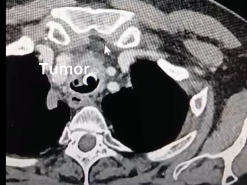 Stenosi neoplastiche delle vie aeree principali: ricanalizzazione con Broncoscopio rigido e&nbsp;laser&nbsp;