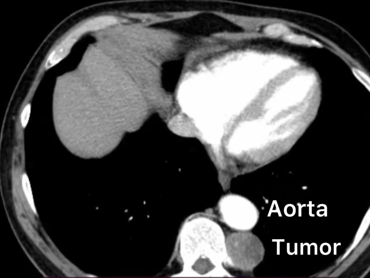 Resezione con tecnica robotica di un neurinoma toracico in contiguità con l’aorta&nbsp;toracica