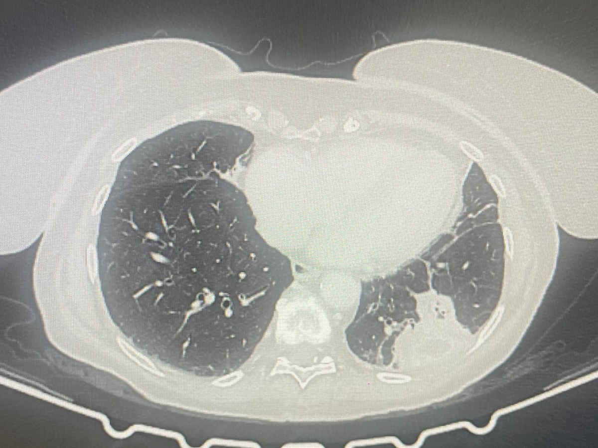 Emorragia intraoperatoria in corso di lobectomia robotica risolta con applicazione di gel emostatico&nbsp;