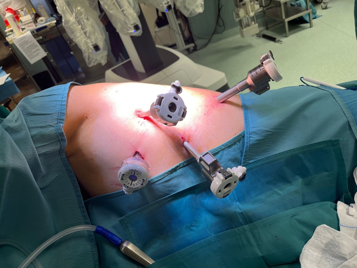 Sezione contemporanea della vena e dei rami arteriosi polmonari superiori in corso di lobectomia superiore&nbsp;destra